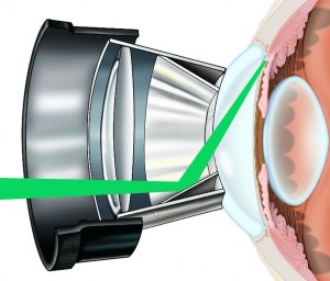 slective laser trabeculoplasty 300x256